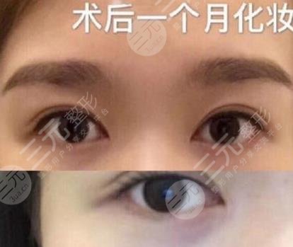 外眼角开大了图片