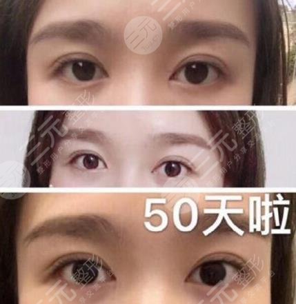外眼角开大了图片