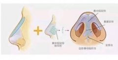 自体软骨隆鼻后遗症有哪些?手术注意事项详解! 自体软骨隆鼻后遗症有哪些?手术注意事项详解!