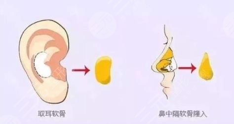 自体软骨隆鼻后遗症有哪些