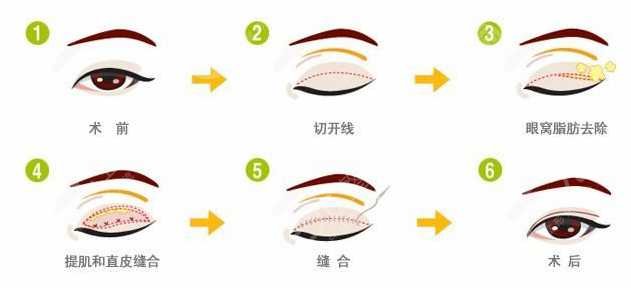 纳米微创双眼皮介绍