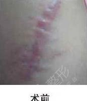 大腿疤痕照片