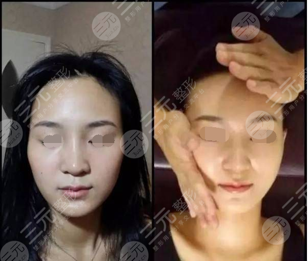 张富源徒手是真的吗?附瘦脸对比图-三元整形网