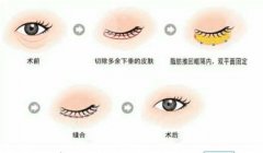 雅皙祛眼袋有吗？医美去眼袋才靠谱！科普分享~