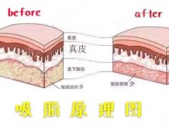 抽脂形体改良怎么做？抽脂手术超全科普一篇解答你的疑问！