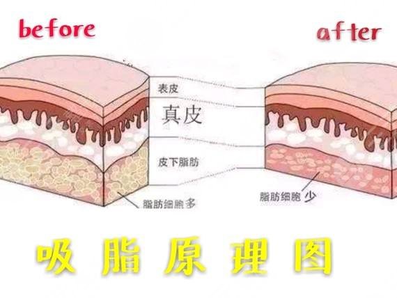抽脂形体改良怎么做