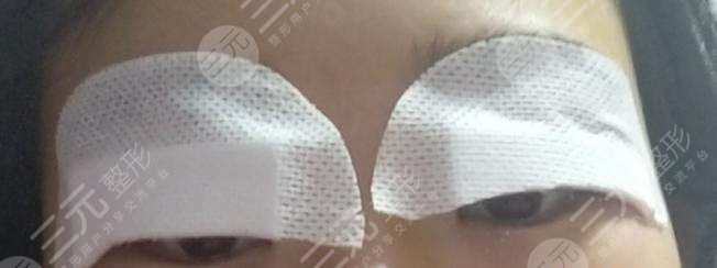 兰大二院整形科专家双眼皮案例