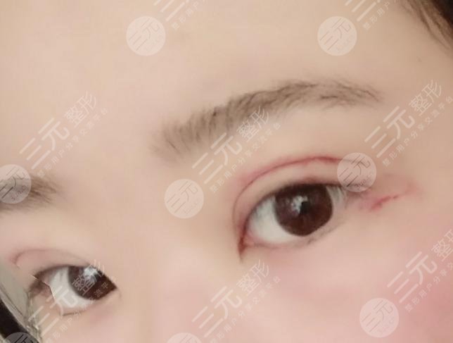 兰大二院整形科专家双眼皮案例