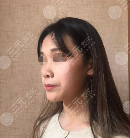 八大处周栩做鼻子隆鼻案例前