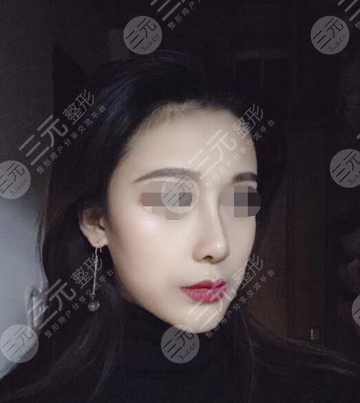 八大处周栩做鼻子隆鼻案例后5周