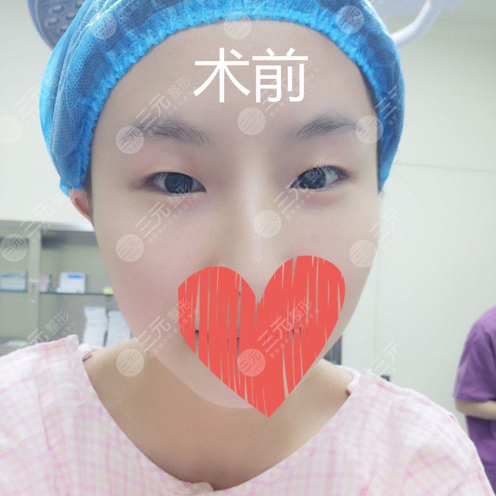 长春铭医整形双眼皮贵吗？双眼皮价目表来袭！附医生简介|双眼皮案例