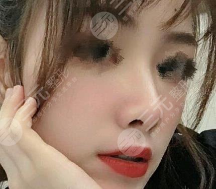 九院韦敏鼻部整形后