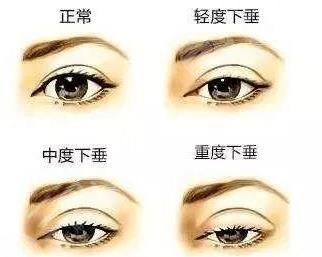 上眼皮松弛的原因有哪些