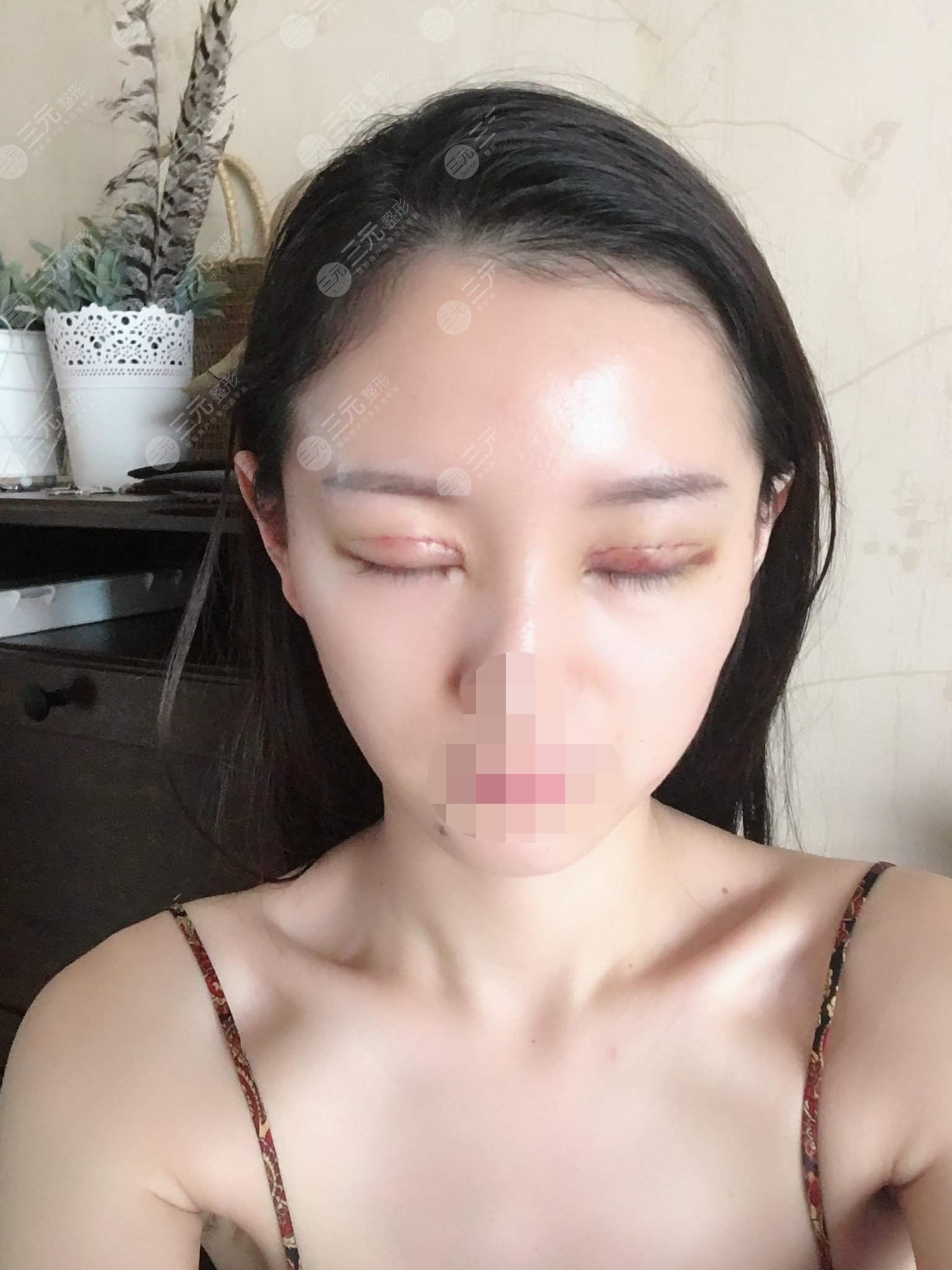 双眼埋线恢复一个月图记录,真是越看越喜欢,快来get同款吧