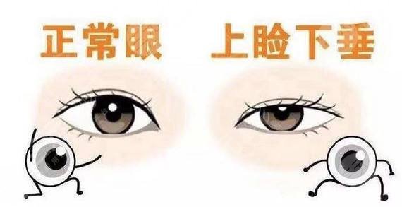 眼睑下垂怎么自己纠正