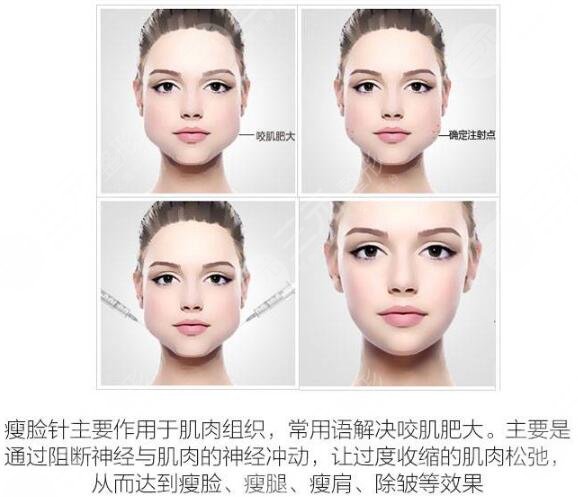 注射瘦脸科普