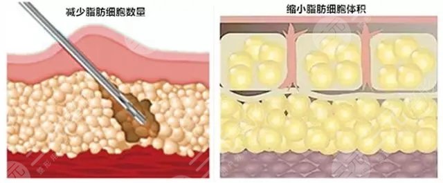 吸脂手术