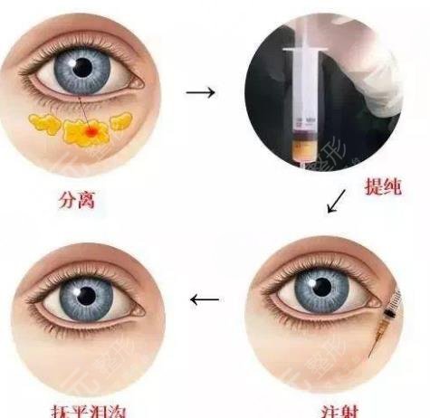 光乳化去眼袋多少钱?术后注意事项汇总~
