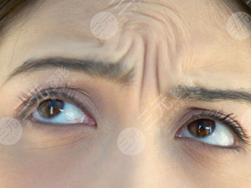 医美抬头纹怎么去除