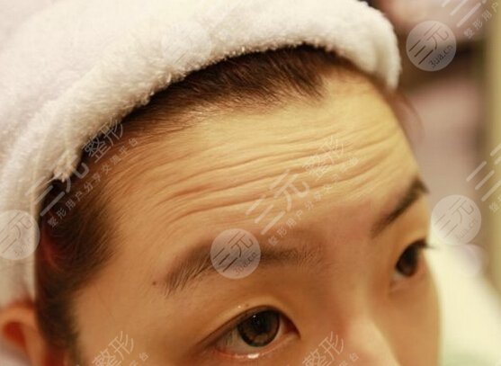医美抬头纹怎么去除?3种有方法摆脱皱纹! 医美抬头纹怎么去除?3种有方法摆脱皱纹!