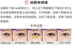 微创祛眼袋手术攻略分享，搞定眼袋，颜值加倍！