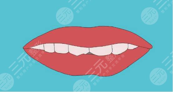 瓜子牙怎么形成的？怎么补救？科普教你恢复美牙！