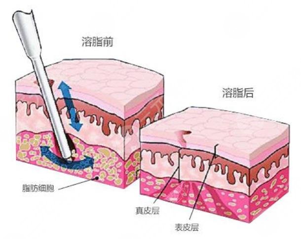 吸脂减肥注意事项