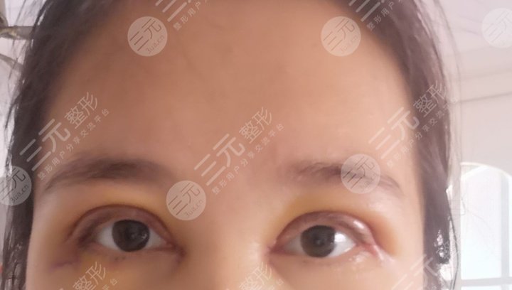 西京医院整形外科孙峰双眼皮案例