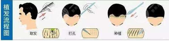 植发失败后的修复
