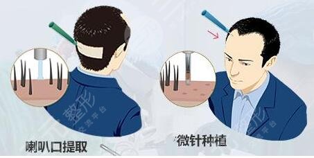 植发手术