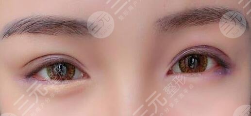 生物焊接双眼皮的真相,生物焊接双眼皮是什么原理?