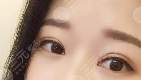生物焊接双眼皮的禁忌症