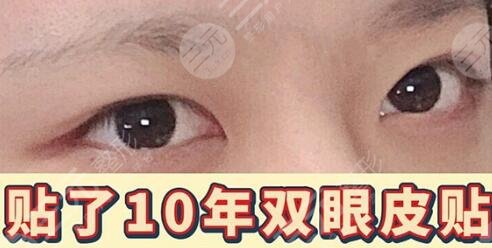 西南医院李喆双眼皮手术前