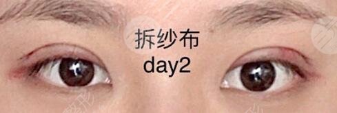 西南医院李喆双眼皮手术后拆线