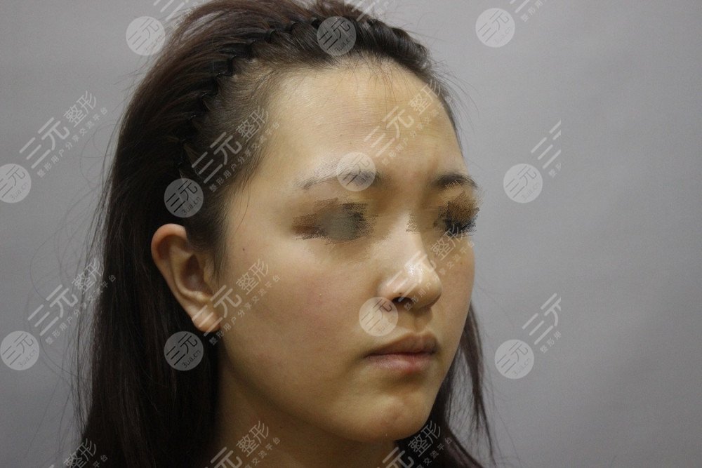 祝东升面部除皱做的怎么样?