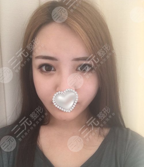 祝东升面部除皱做的怎么样?