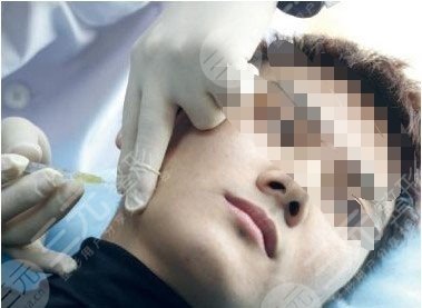 男生打注射瘦脸好吗？果图对比照片看看，妥妥变帅！