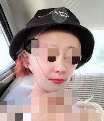 面部光纤溶脂后悔