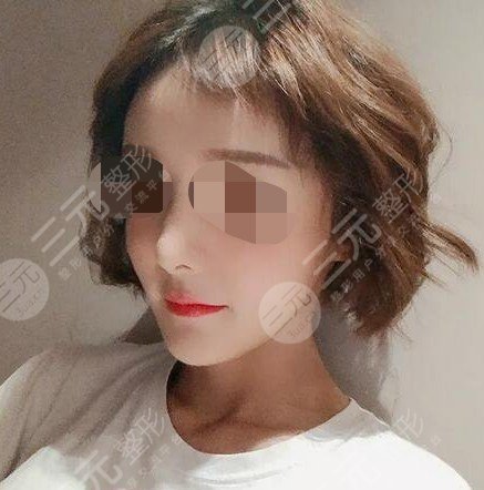 面部光纤溶脂后悔