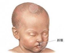 兔唇修复后果图片好吗？兔唇修复手术需要几期？