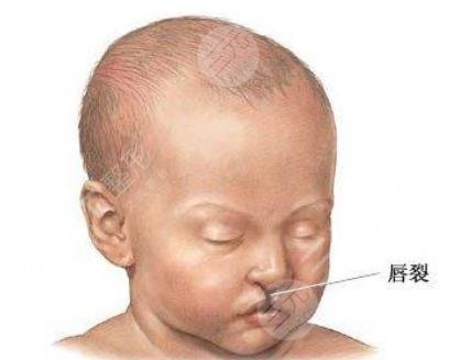 兔唇修复后果图片好吗？兔唇修复手术需要几期？