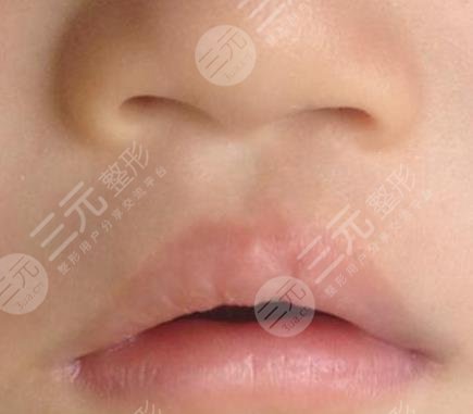 兔唇修复手术需要几期?