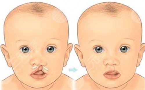 兔唇术后会有上颌凹陷的情况