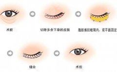 眼袋切除手术能保几年？如何避免眼袋的形成？