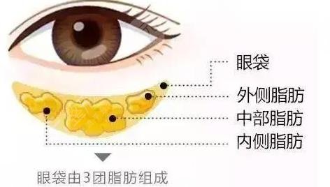 眼袋切除手术能保几年