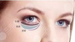 雅皙祛眼袋有吗？轻医美去眼袋方法科普！