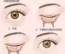 内路去眼袋多久能恢复？降低风险吗？科普为你揭秘！