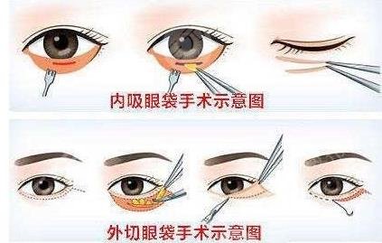 内路去眼袋