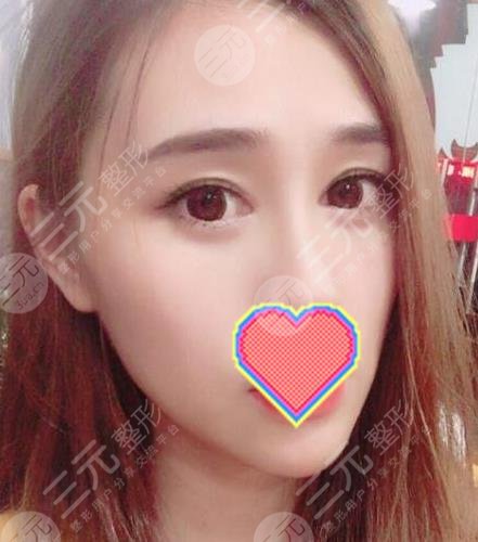 去眼袋术后三个月