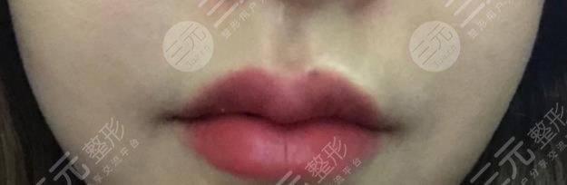丰唇术后一周